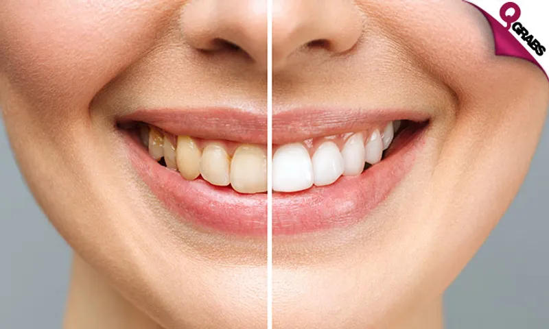 Zoom Teeth Whitening + Consultation at Ocean Medical Center!